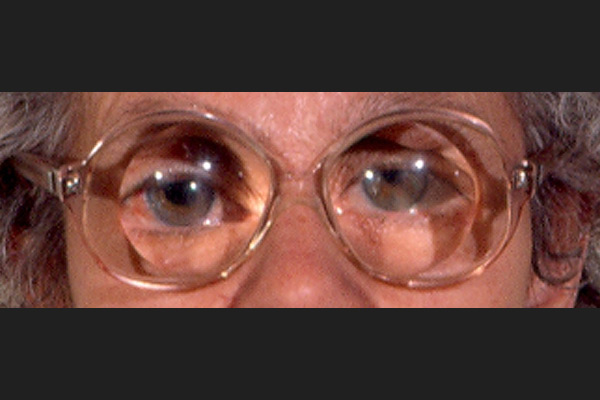 Patiente porteuse de lunettes d’aphake